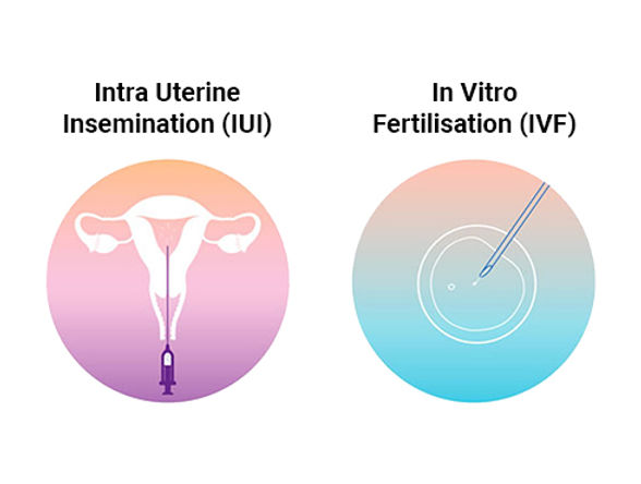 Illustration comparing IUI and IVF fertility treatments
